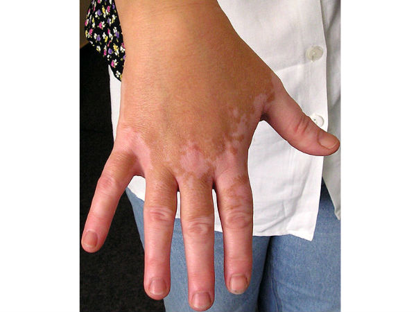 पुणे, skin disease, disease, pune, mumbai, मुंबई, स्पा, मसाज पुणे, skin disease, disease, pune, mumbai, मुंबई, स्पा, मसाज