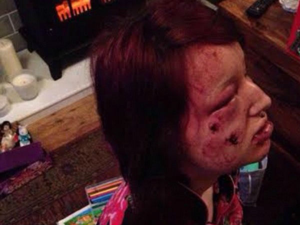 Her boyfriend tried to eat her, bit her face 21 times Her boyfriend tried to eat her, bit her face 21 times