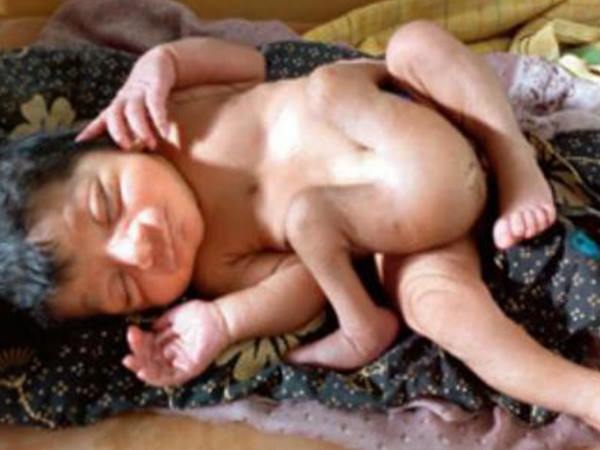 baby child कर्नाटक में जन्मा चार पैर और दो जननांग वाला बच्चा, डॉक्टर हैरान baby child कर्नाटक में जन्मा चार पैर और दो जननांग वाला बच्चा, डॉक्टर हैरान