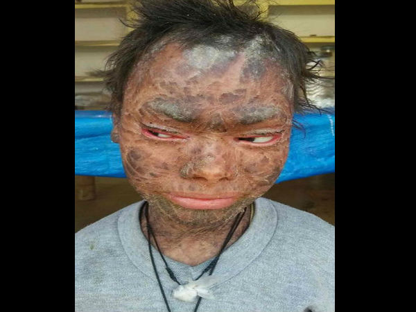 Human snake' girl sheds her skin every two months because of ultra-rare condition Human snake' girl sheds her skin every two months because of ultra-rare condition