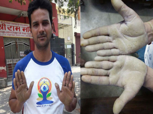 man lost his job due to no fingerprints in his hand man lost his job due to no fingerprints in his hand