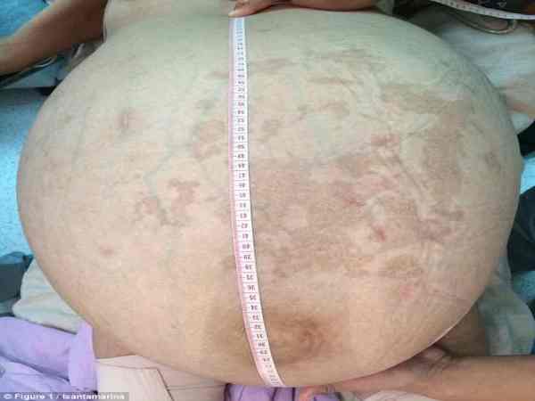 गर्भाशय से निकला ट्यूमर