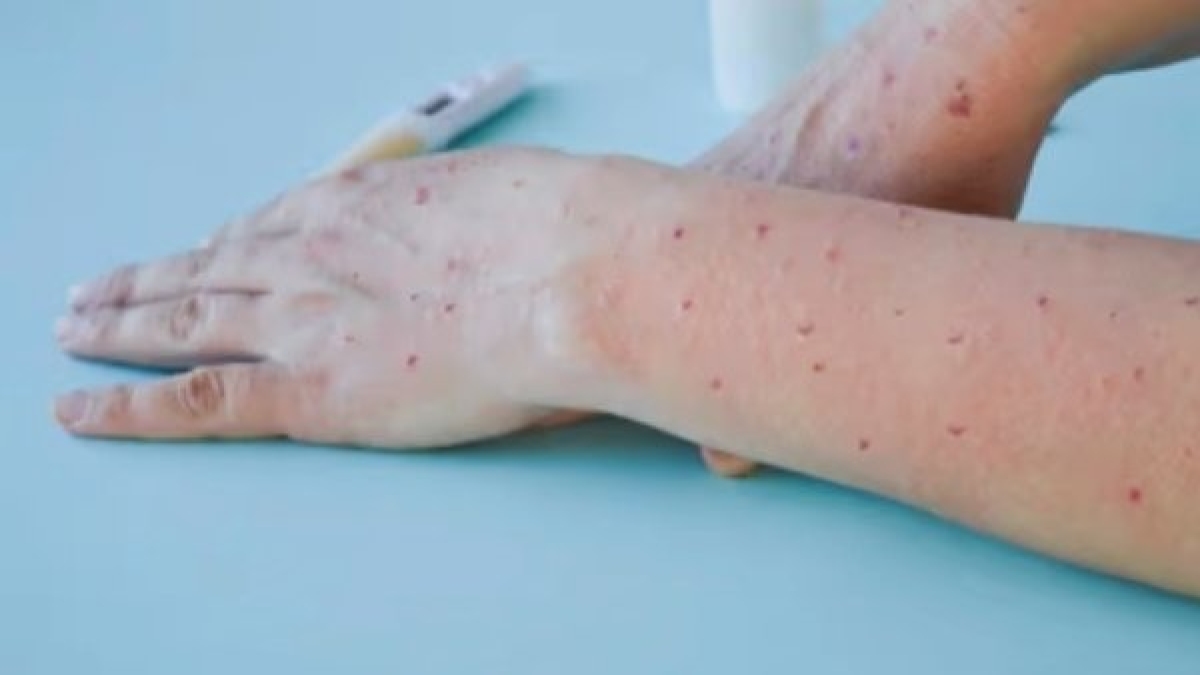 Monkeypox Monkeypox