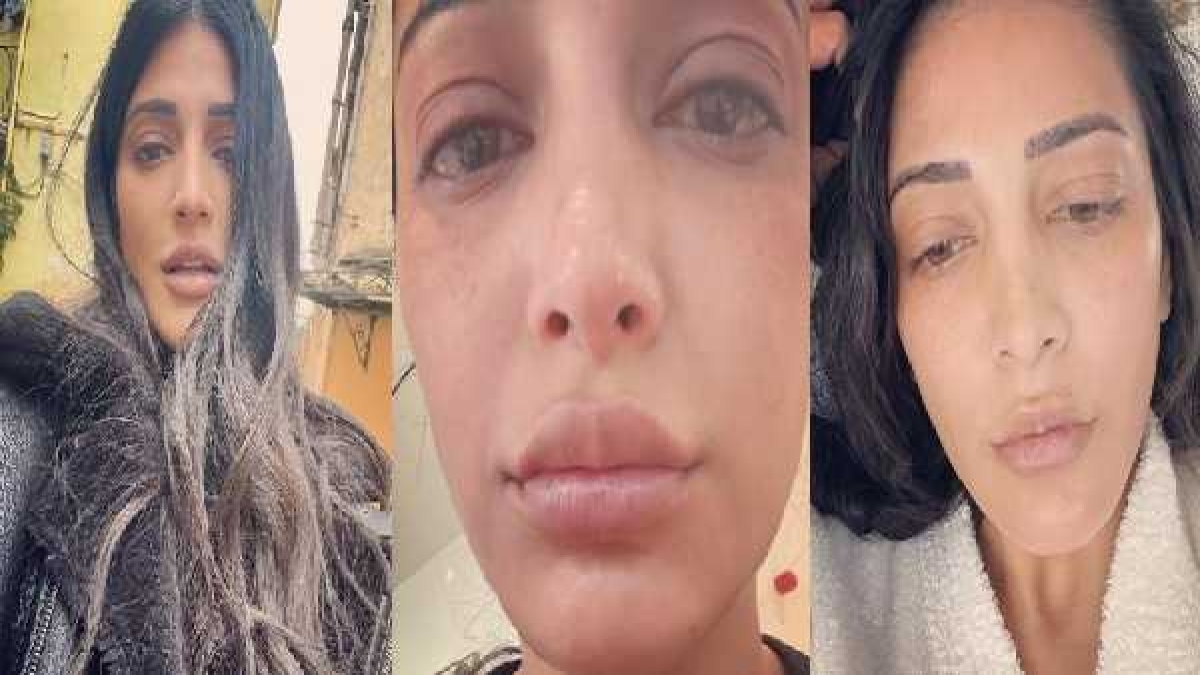सूज गया है श्रुति हासन का मुंह