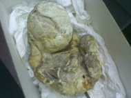 नागपुर में एक महिला के पेट से 15 साल पुराना भ्रूण निकाला