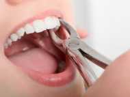 Gwalior news:सड़े दांत की जगह उखाड़ दिया मरीज का अच्छा दांत, डॉक्टर पर मामला दर्ज