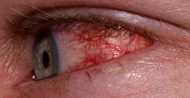 आंसुओं से भी क्या फ़ैल सकता है कोरोनावायरस?आंखों का लाल होना भी है संक्रमण का है लक्षण