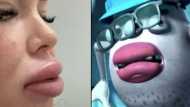 खूबसूरत होंठ पाने के चक्कर में Monster जैसी दिखने लगी महिला, शीशा देखकर चिल्लाई, डॉक्टरों ने किया ये काम