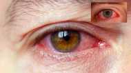 Eye Flu: बरसात के मौसम में तेजी से फैल रहा है Conjunctivitis, जानें कारण और कैसे रखें आंखों का ख्‍याल
