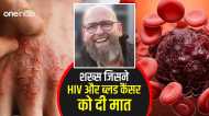 HIV और कैंसर जैसी बीमारी से जूझ रहा था ये शख्स, ऐसे हुआ इलाज और बच गई जान, डॉक्टर भी हुए हैरान
