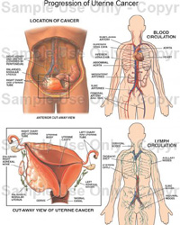 uterine cancer