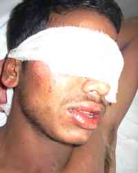 Acid victim Acid victim