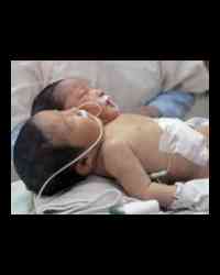 2 headed infant 2 headed infant