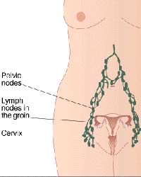 cervical cancer cervical cancer
