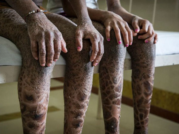 rare skin disease rare skin disease