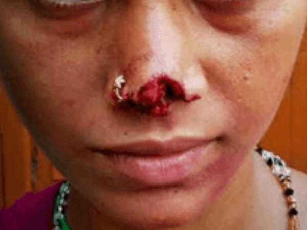 शाहजहांपुर: झगड़ा हुआ तो पति ने दांतों से पत्नी की नाक को काट डाला शाहजहांपुर: झगड़ा हुआ तो पति ने दांतों से पत्नी की नाक को काट डाला