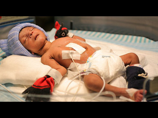 A baby born with 4 legs and 2 penises has had a successful operation to remove the extra appendages A baby born with 4 legs and 2 penises has had a successful operation to remove the extra appendages