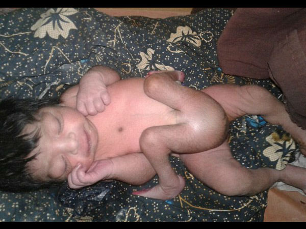 A baby born with 4 legs and 2 penises has had a successful operation to remove the extra appendages A baby born with 4 legs and 2 penises has had a successful operation to remove the extra appendages