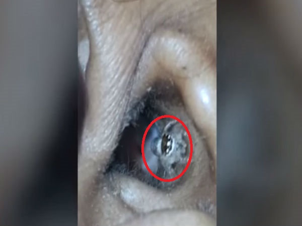 TERRIFYING moment when a spider crawled out of Karnataka woman’s ear at hospital - Watch video TERRIFYING moment when a spider crawled out of Karnataka woman’s ear at hospital - Watch video