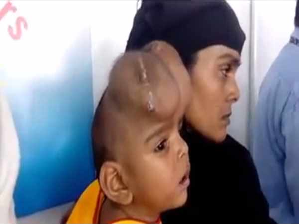 दो भागों में बंटे सिर को काटकर बनाया एक, डॉक्टर ने बनाया रिकार्ड दो भागों में बंटे सिर को काटकर बनाया एक, डॉक्टर ने बनाया रिकार्ड