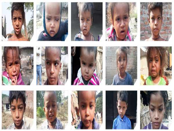 Measles become curse of a village in Bahraich, 40 children ill Measles become curse of a village in Bahraich, 40 children ill
