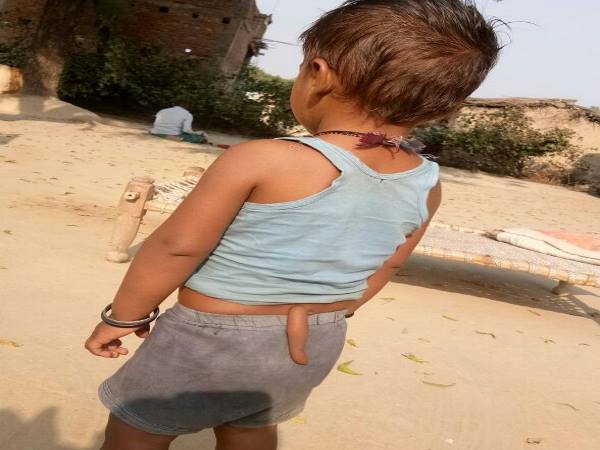 20 हजार लोगों में किसी एक को होती है समस्या