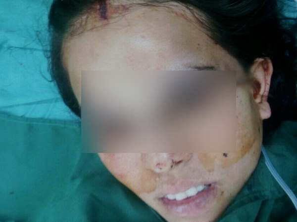 Head of woman trapped in vacuum cleaner in Pune Head of woman trapped in vacuum cleaner in Pune