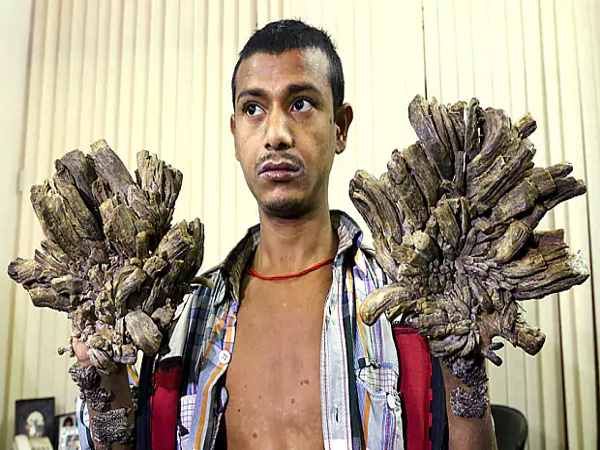 दोबारा सामने आई बीमारी