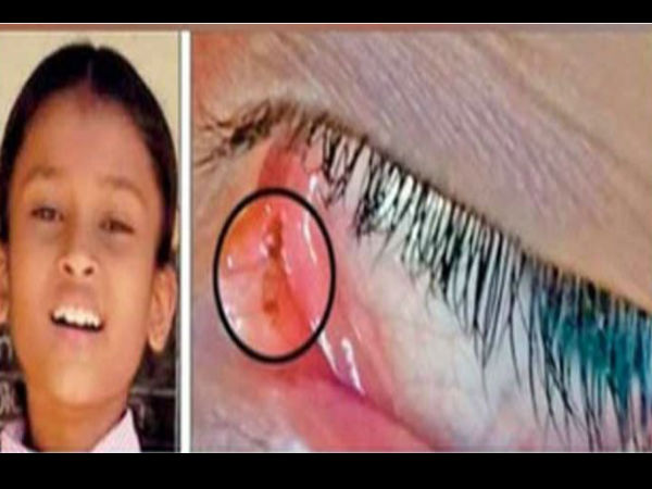 10 दिनों से आंख से निकल रही हैं चीटियां
