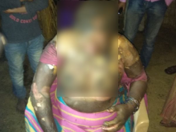 balia woman burnt by two men balia woman burnt by two men