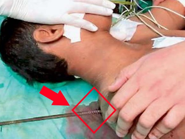 लिवर, फेफड़े में घुसा था सरिया