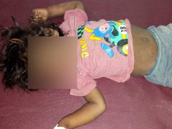 Three children died due to Measles in Bahraich Three children died due to Measles in Bahraich