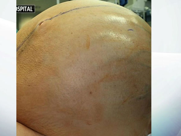 132-pound ovarian tumor removed from Connecticut woman 132-pound ovarian tumor removed from Connecticut woman