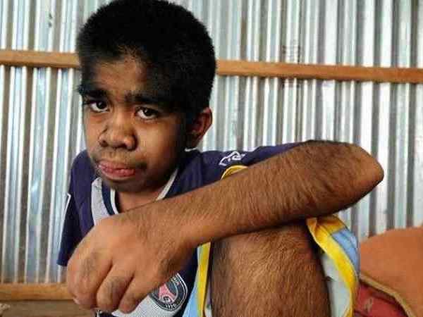 indonesian boy rehan suffering from werewolf genetic disorder indonesian boy rehan suffering from werewolf genetic disorder