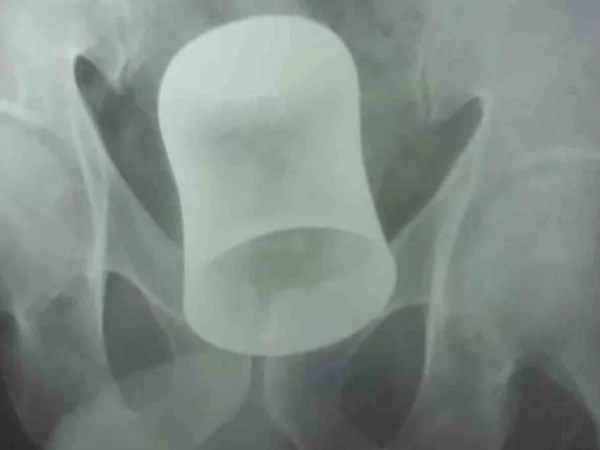 बदमाशों ने मारपीट करने के बाद गुदा द्वार में डाल दिया था गिलास