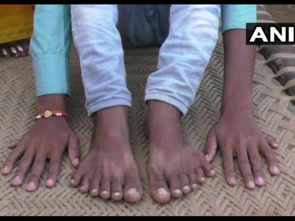 यूपी: बाराबंकी के इस लड़के की हैं 24 उंगलियां, अमीर बनने के लिए रिश्तेदार देना चाहते हैं बलि यूपी: बाराबंकी के इस लड़के की हैं 24 उंगलियां, अमीर बनने के लिए रिश्तेदार देना चाहते हैं बलि