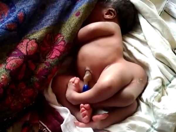 Baby born with four legs in Gorakhpur Baby born with four legs in Gorakhpur