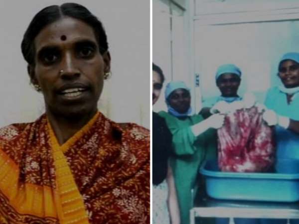 Coimbatore: Doctors remove 33.5 kg ovarian tumor, eye on world record Coimbatore: Doctors remove 33.5 kg ovarian tumor, eye on world record
