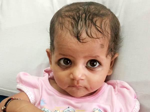11 महीने की शिवानी की सर्जरी के लिए नहीं है मां-बाप के पास पैसे 11 महीने की शिवानी की सर्जरी के लिए नहीं है मां-बाप के पास पैसे