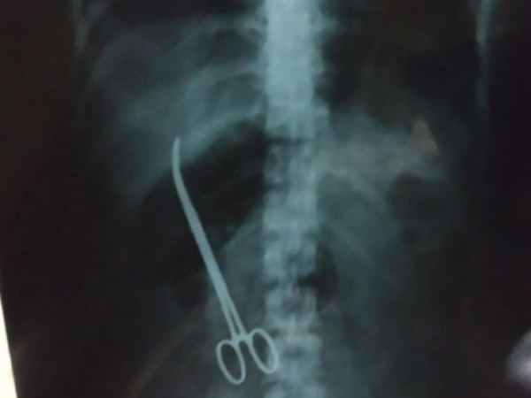 hyderabad surgeon left forceps in stomach of woman hyderabad surgeon left forceps in stomach of woman