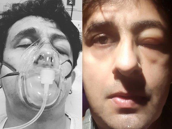कुछ दिन पहले सी फूड्स से हुई एलर्जी