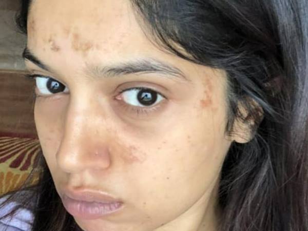 भारी मेकअप के चलते जला भूमि का चेहरा