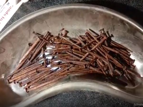 115 Nails of iron come out from patients stomach in Bundi Rajasthan 115 Nails of iron come out from patients stomach in Bundi Rajasthan