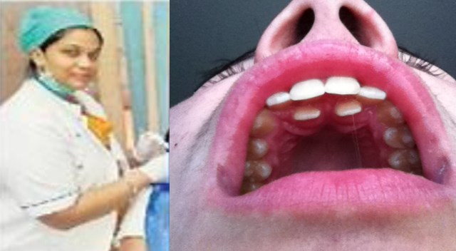 14 year old girl have 50 teech in her Mouth in Kota 14 year old girl have 50 teech in her Mouth in Kota