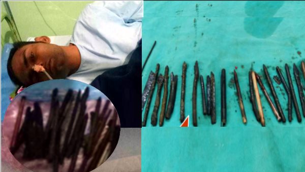 33 items of iron Found in stomach of Chhatarpur Young Man 33 items of iron Found in stomach of Chhatarpur Young Man
