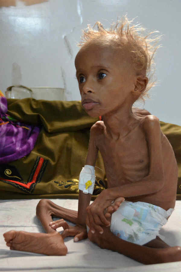 malnutrition malnutrition
