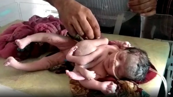 Four handed child born in Malpura CHC Tonk Rajasthan Four handed child born in Malpura CHC Tonk Rajasthan