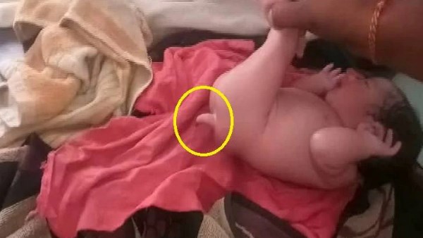 child born with tail in greater noida child born with tail in greater noida