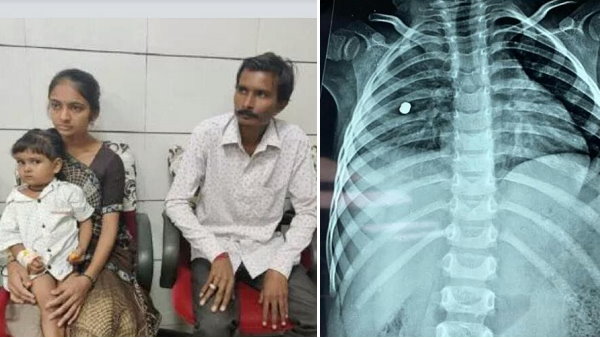 2 years girl baby shots by her brother, doctors saves life 2 years girl baby shots by her brother, doctors saves life