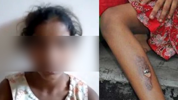 Step Mother Burns 12 year old Daughter With Hot Tongs in Udaipur Step Mother Burns 12 year old Daughter With Hot Tongs in Udaipur